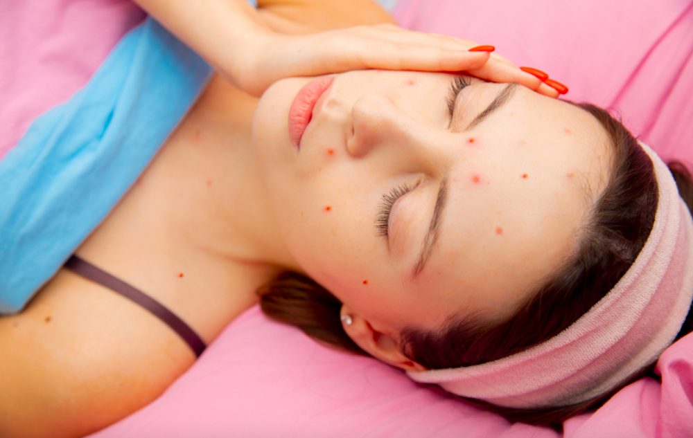 cach cham soc da khong de lai seo sau khi bi thuy dau 1